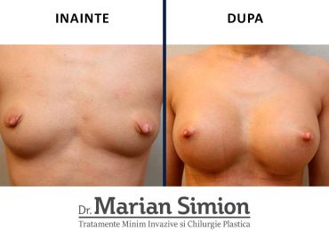 implant-mamar-before-after-2