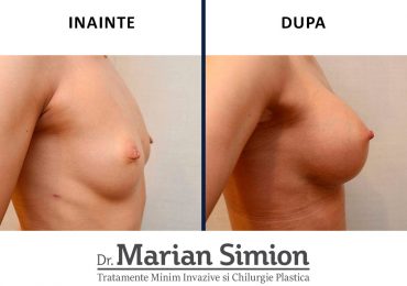 implant-mamar-before-after-3